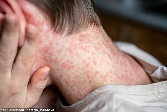 Measles Outbreak at Dilley Immigration Center Sparks Public Health Crisis, Prompting ICE Quarantine Measures