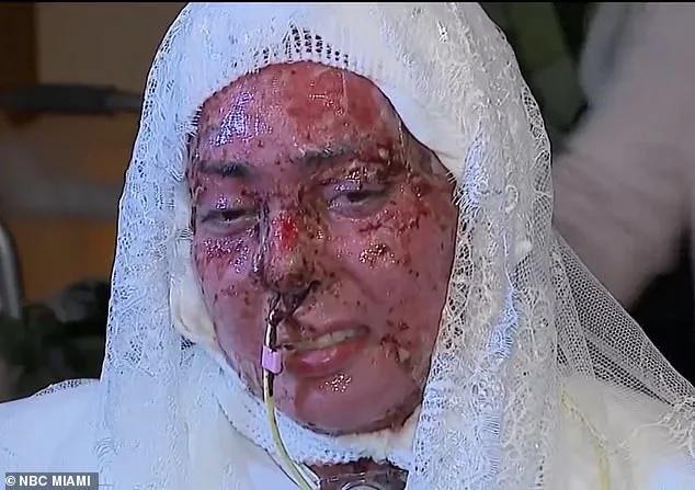 Survivor of Grill Explosion Ties the Knot in Hospital Chapel, Sparking Safety Debates